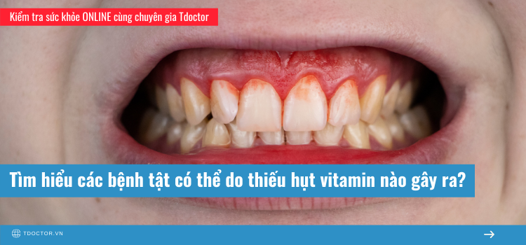 Tìm hiểu các bệnh tật có thể do thiếu hụt vitamin gây ra?